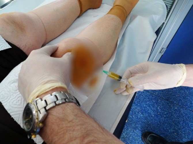 Diz Kireçlenmesinde Prp Tedavisinde Bunlara Dikkat