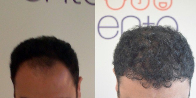 Saç Ekimi Operasyonlarında Şapka Uyarısı