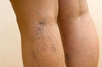 Lazer Teknolojisiyle Varis Tedavisi