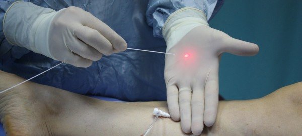 Lazer Teknolojisiyle Varis Tedavisi