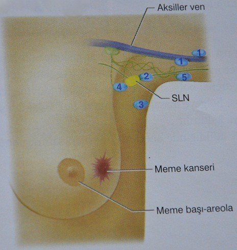 Meme Kanseri Cerrahisinde Son Nokta
