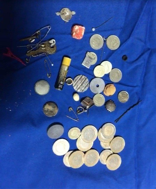 Çocukların Yuttukları Cisimler Görenleri Şaşırtıyor