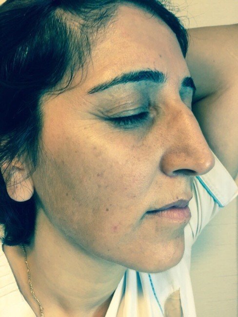 Leke Tedavisinde Son Yöntem