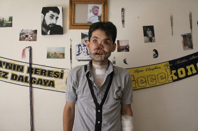 Yüzünde Tüfek Fişeği Patlayan Ahmet İlk Ameliyatını Oldu