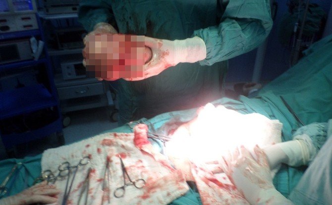 Karnından İki Buçuk Kilo Ur Çıktı